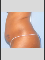 Before Photo UltraShape Focused Ultrasound Female Abdomen - Prejuvenation Before & After