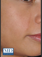 After Photo Post Inflammatory Hyperpigmentation 119 - Prejuvenation Before & After