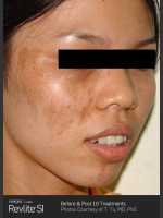 Before Photo Before and After Revlite SI Series of Treatments for Melasma - Prejuvenation Before & After