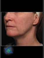 After Photo Profound Facial Laxity Treatment - Prejuvenation Before & After