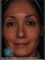 After Photo Treatment of Melasma - Prejuvenation Before & After