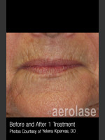 After Photo Treatment of Melasma #317 - Prejuvenation Before & After