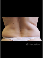 Before Photo CoolSculpting Before & After on Woman - Prejuvenation Before & After