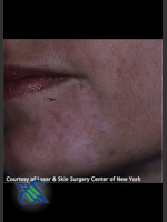 After Photo Left Chin Treatment of Facial Cafe au Lait - Prejuvenation Before & After