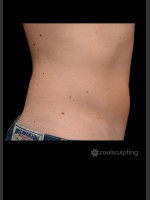 After Photo CoolSculpting Before & After on Man - Prejuvenation Before & After