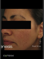 After Photo Melasma Before & After Photo after Laser Genesis - Prejuvenation Before & After