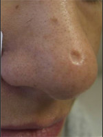 Before Photo Treatment of Nose Acne Scar - Prejuvenation Before & After