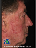 Before Photo Male Full Face Fraxel Treament - Prejuvenation Before & After