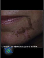 Before Photo Left Chin Treatment of Facial Cafe au Lait - Prejuvenation Before & After