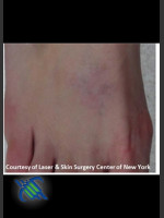 After Photo Laser Treatment of Foot Tattoo - Prejuvenation Before & After