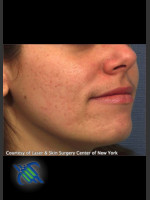 Before Photo Facial Acne Scaring Treatment - Right Side  - Prejuvenation Before & After