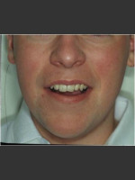 After Photo Rosacea treated by laser. - Prejuvenation Before & After