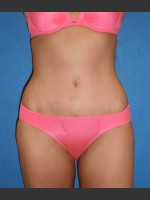 After Photo Tummy Tuck Case #1 - Prejuvenation Before & After