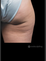 Before Photo CoolSculpting Before & After on Woman - Prejuvenation Before & After