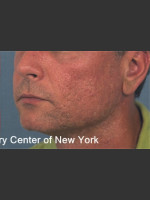 After Photo Treatment of Facial  Acne Scars - Prejuvenation Before & After