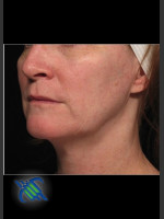 Before Photo Profound Facial Laxity Treatment - Prejuvenation Before & After