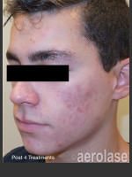 After Photo NeoClear by Aerolase Acne Treatment - Prejuvenation Before & After
