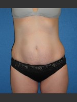 Before Photo Tummy Tuck Case #1 - Prejuvenation Before & After