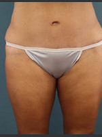 After Photo Before and After Tummy Tuck - Prejuvenation Before & After