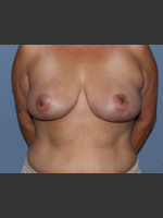 After Photo Breast Lift Case #1 - Prejuvenation Before & After