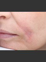 After Photo Traumatic scar  - Prejuvenation Before & After