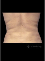 After Photo CoolSculpting on Woman's Love Handles - Prejuvenation Before & After