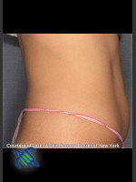 After Photo Treatment of Lower Abdomen Right Side - Prejuvenation Before & After