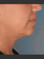 Before Photo Kybella Treatment 34 Year Old Female - Prejuvenation Before & After