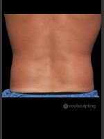 After Photo CoolSculpting Before & After on Man - Prejuvenation Before & After