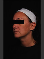 Before Photo Treatment of Melasma - Prejuvenation Before & After