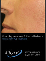 After Photo Treatment of Pigmentation and Melasma  - Prejuvenation Before & After