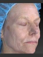 Before Photo Wrinkle and Brown Spot Reduction - Prejuvenation Before & After