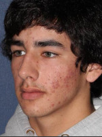 Before Photo Treatment of Acne  - Prejuvenation Before & After