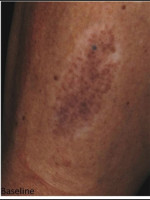 Before Photo Treatment of Tattoo - Prejuvenation Before & After