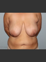 Before Photo Breast Lift Case #1 - Prejuvenation Before & After