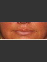 After Photo Lip Plumping Treatment - Prejuvenation Before & After