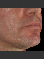 After Photo Infini Acne Scar Treatment #13 - Prejuvenation Before & After