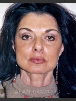 After Photo Rhytidectomy (Facelift) 1884 - Prejuvenation Before & After
