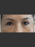Before Photo Undereye Filler - Prejuvenation Before & After