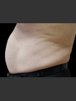 After Photo Body Contouring Treatment #116 - Prejuvenation Before & After