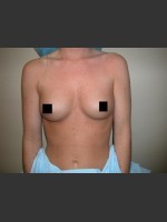 Before Photo Breast Augmentation - Prejuvenation Before & After