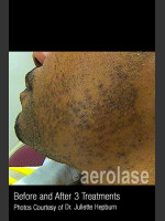 Before Photo Hair Removal #314 - Prejuvenation Before & After