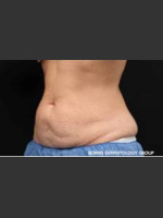 Before Photo CoolSculpting Treatment of Woman's Abdomen - Prejuvenation Before & After