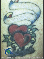 After Photo Treatment of Arm Tattoo - Prejuvenation Before & After