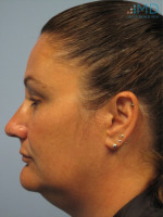 Before Photo Exilis Skin Tightening - Prejuvenation Before & After