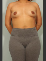 Before Photo Breast Augmentation - Prejuvenation Before & After