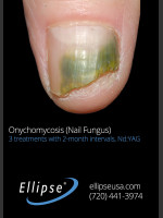 Before Photo Treatment of Toe Nail Fungus - Prejuvenation Before & After