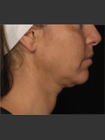 Before Photo Treatment of Neck Contour - Prejuvenation Before & After
