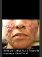 Before Photo Treatment of Cystic Acne #300 - Prejuvenation Before & After