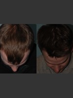 After Photo Neograft Hair Transplant - Prejuvenation Before & After